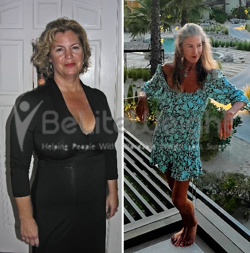 Weight Loss Surgery Before and After